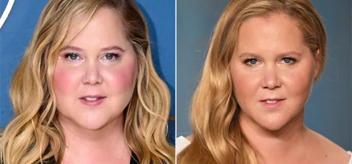 Amy Schumer Says Comments About Her 'Moon Face' Led to Cushing Syndrome Diagnosis: 'I Wouldn't Have Known' 1