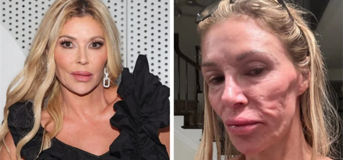 ‘Real Housewives’ Star Brandi Glanville Says ‘Parasite That Jumps Around my Face’ is Responsible for Dramatic Change in Appearance 1