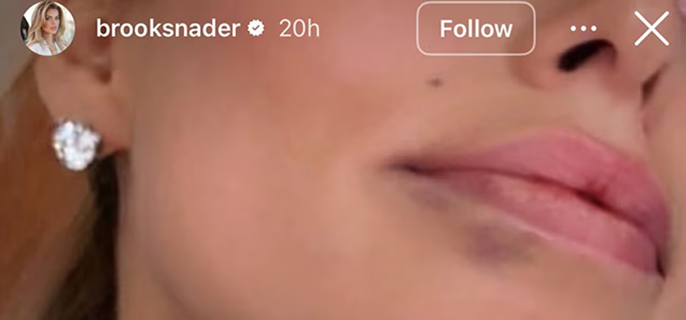 Brooks Nader Dissolves Lip Filler as Christmas Gift to Her Parents 1