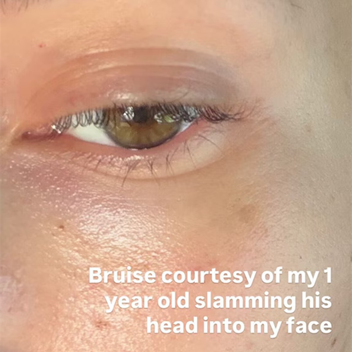 Hailey Bieber Reveals Bruised Eye After Baby Jack Accidentally Slams His Head Into Her Face