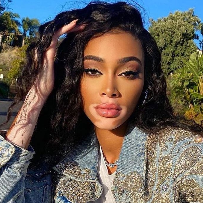 Winnie Harlow takes new educational initiative to normalise vitiligo