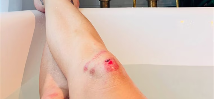 Katy Perry Shares Photo of Bloody Knee Injury After Concert Mishap 1